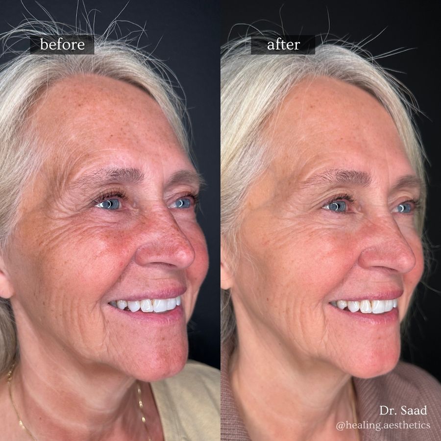 Before and after Sculptra: restored cheek fullness and a brighter complexion