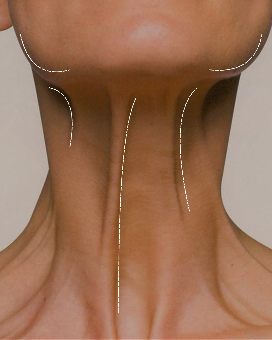 Neck bands Botox treatment — platysmal bands and Nefertiti lift for neck rejuvenation