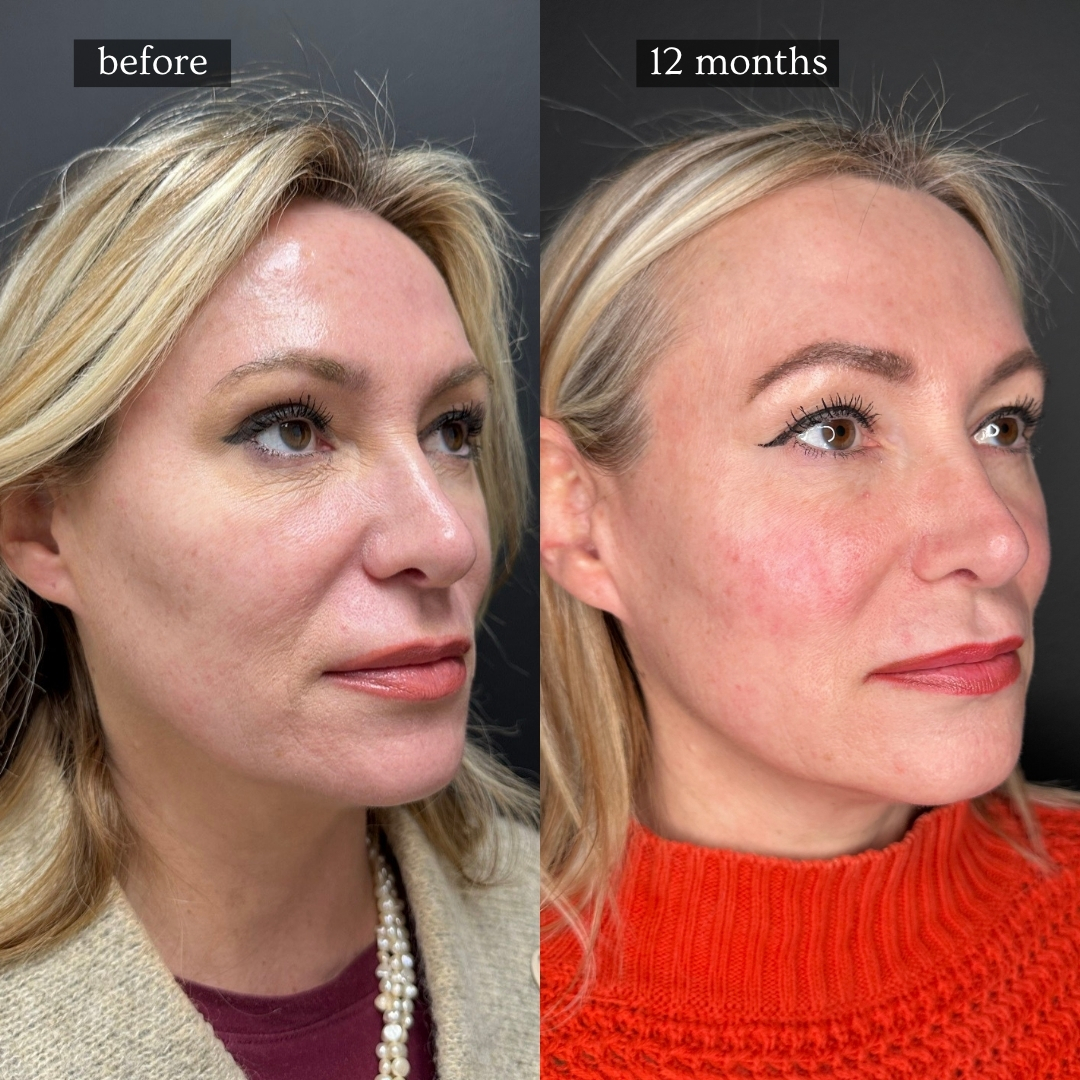 Sculptra before and after — real Hinsdale patient, 12 months