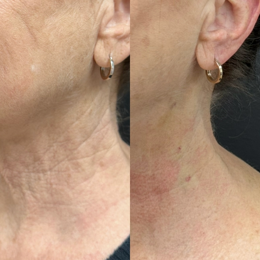 Before and after neck skin tightening and rejuvenation