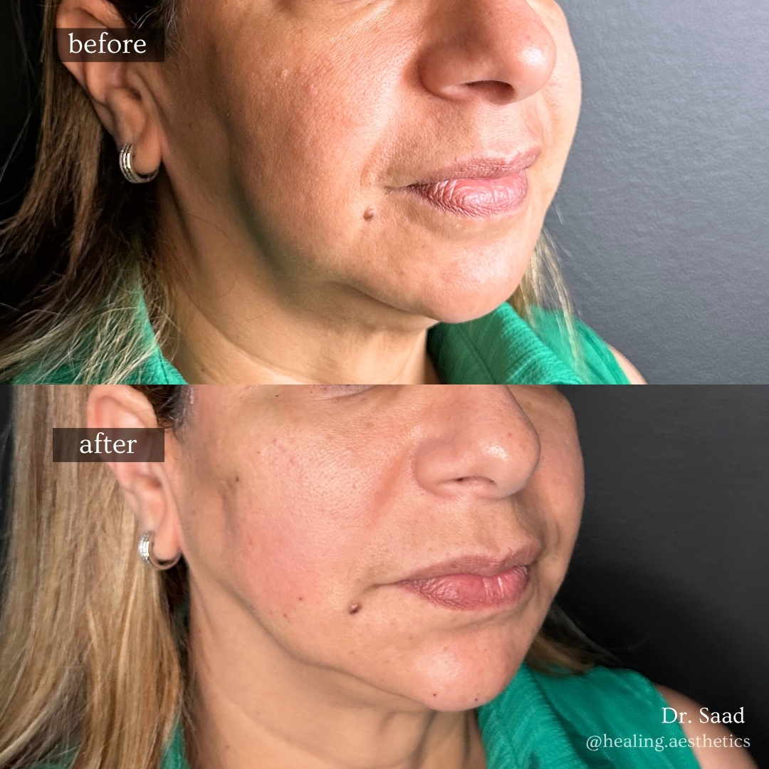 Before and after acne scar treatment at Healing Aesthetics