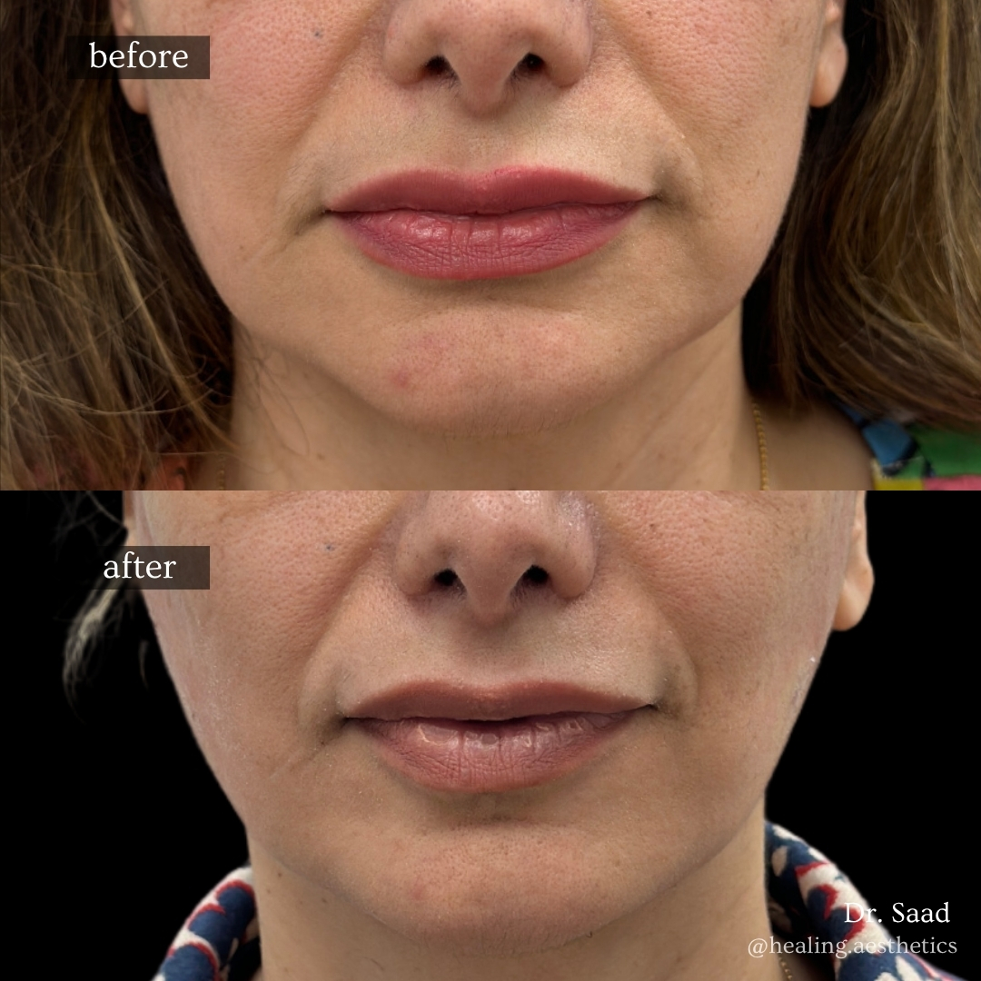 Before and after IPL photofacial for sun spots at Healing Aesthetics