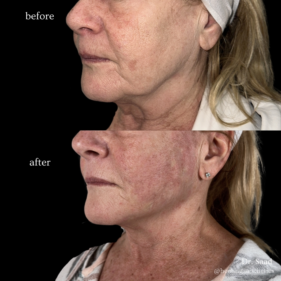 Before and after non-surgical face and neck lift