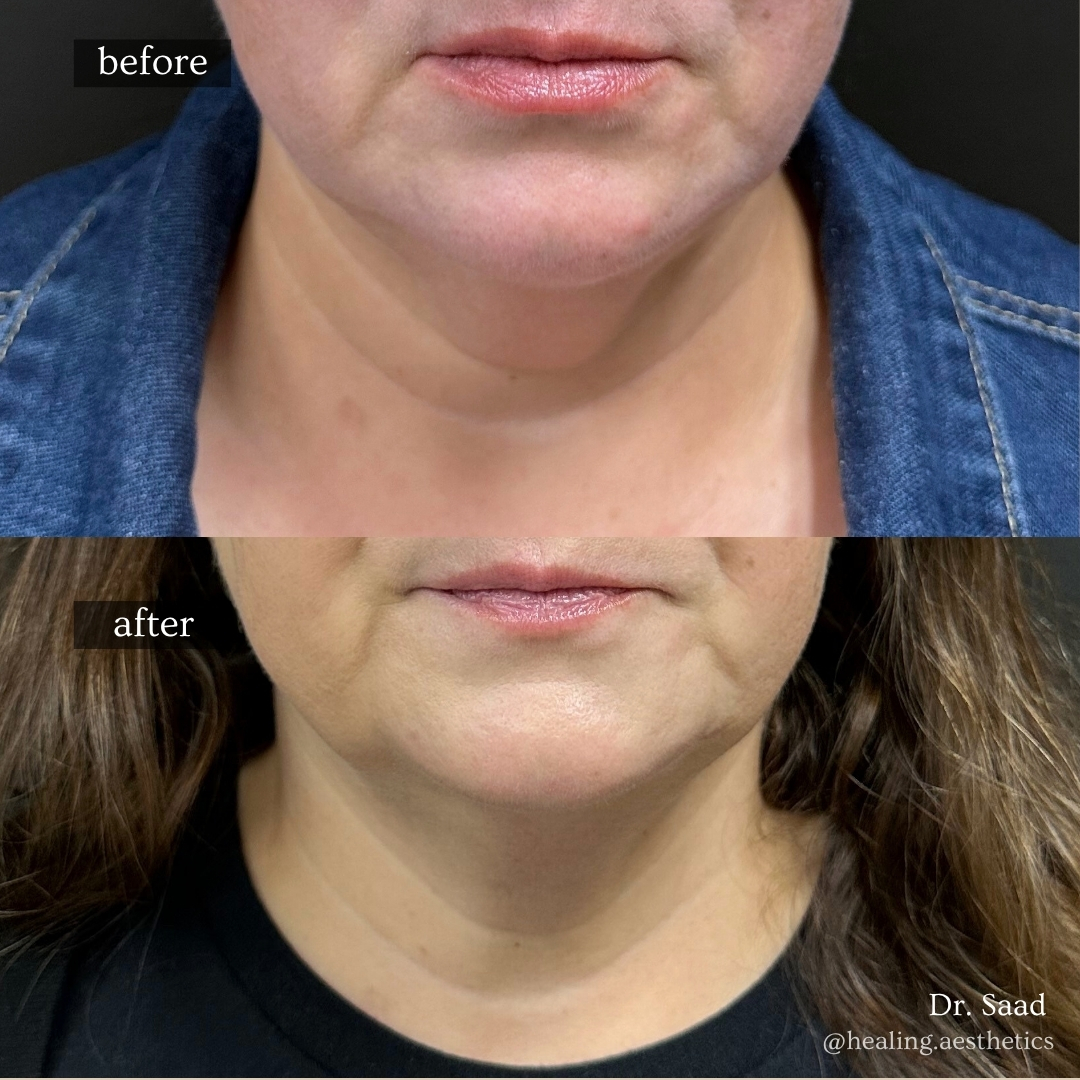 Before and after double chin fat reduction
