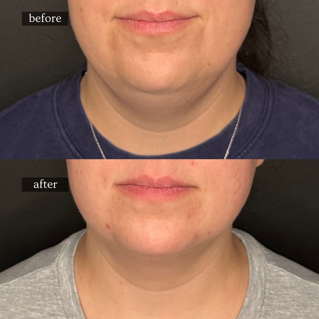 Fat dissolve before and after — double chin and submental fullness reduced for a cleaner jawline, Hinsdale IL