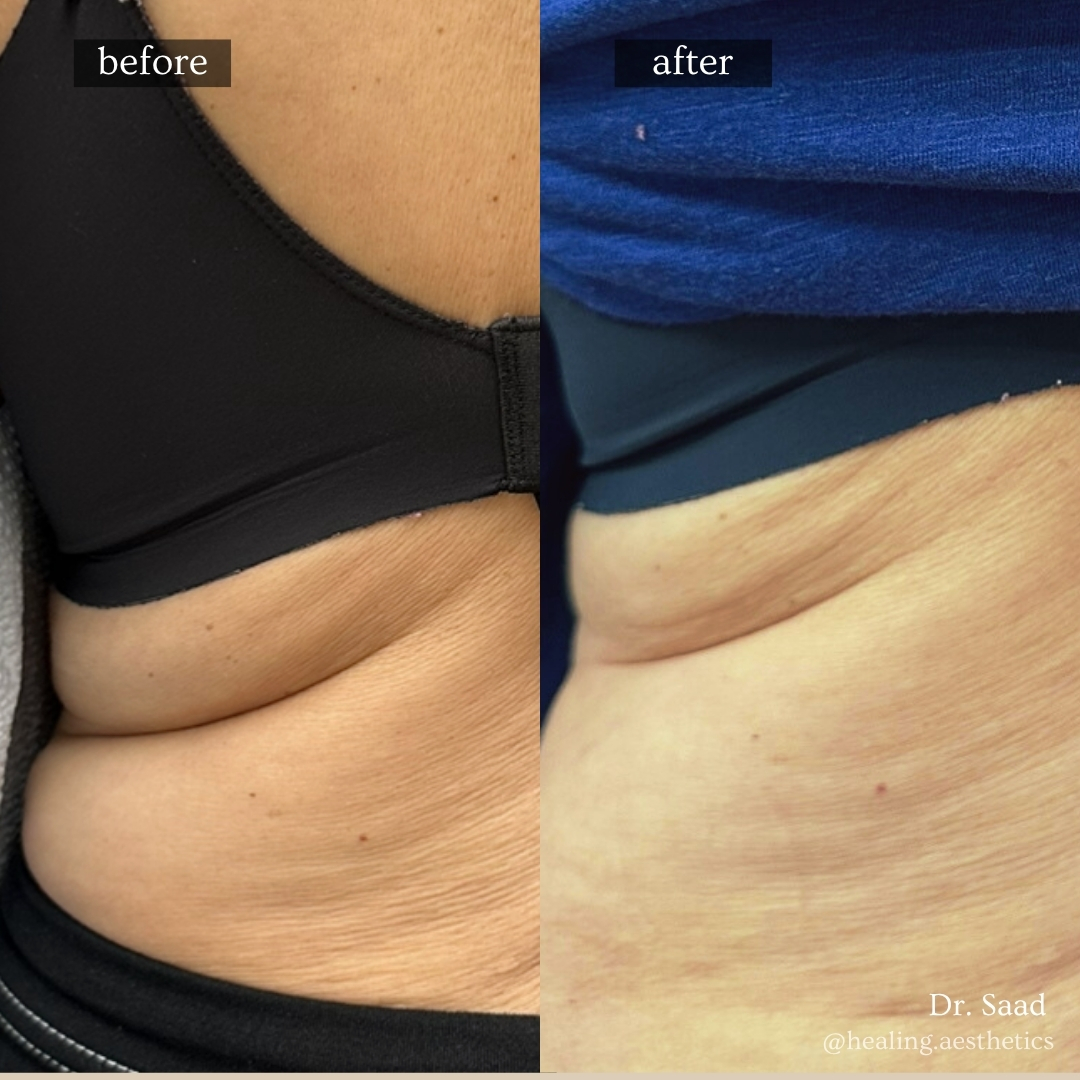 Before and after flank and love handle fat-dissolve contouring