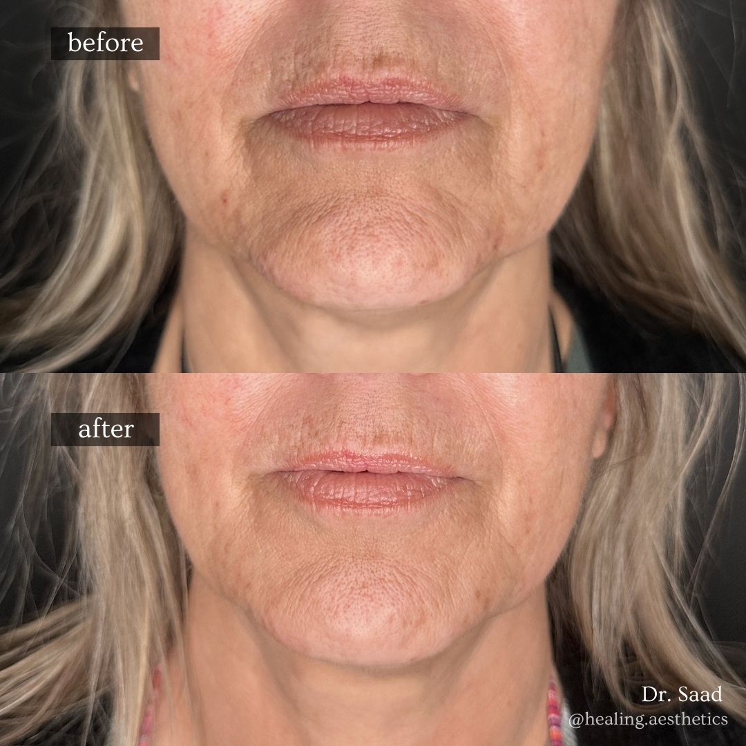 Before and after lower-face rejuvenation smoothing marionette lines and defining the jawline