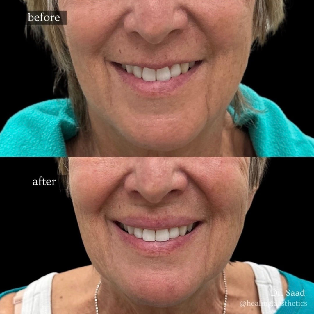 Before and after lip enhancement treatment at Healing Aesthetics