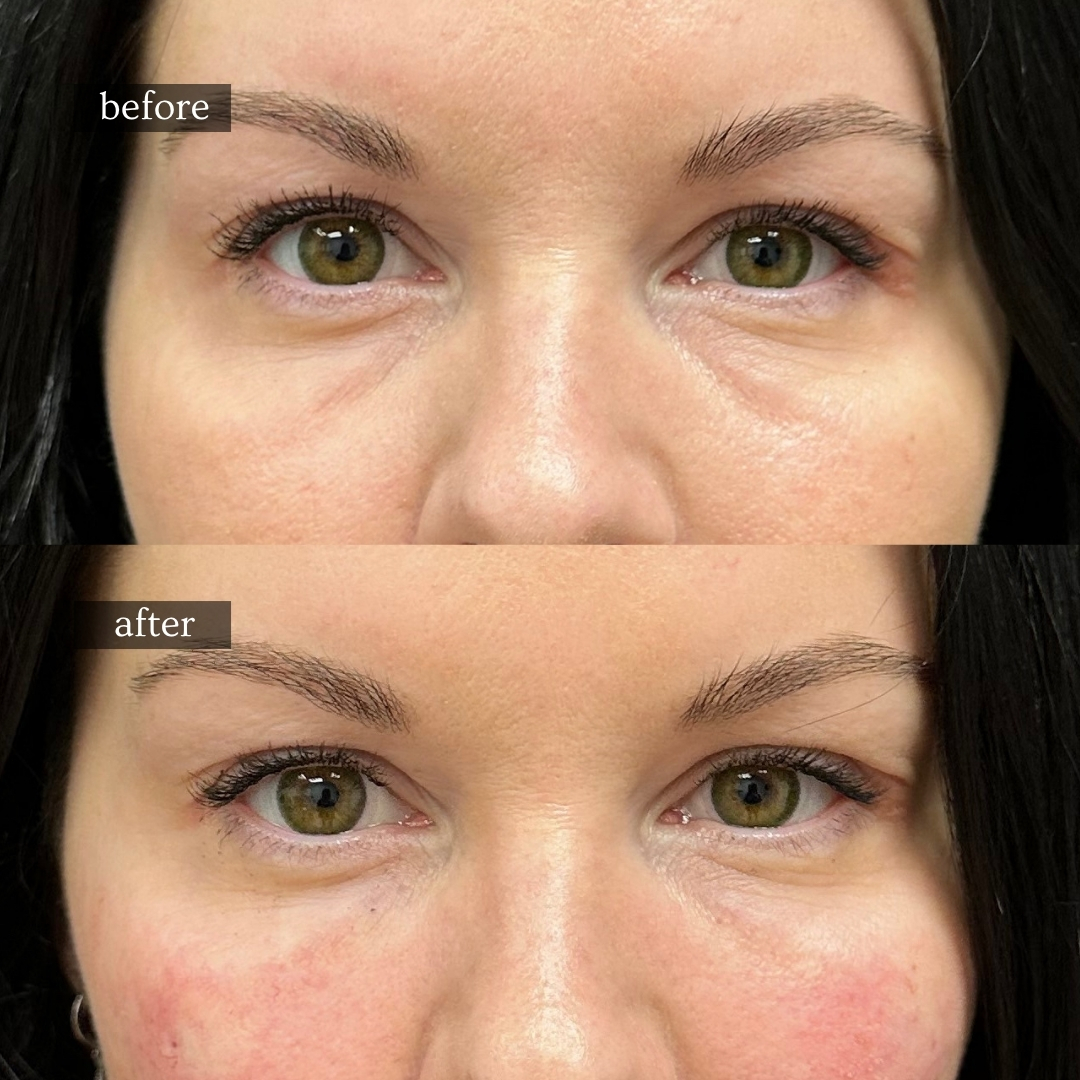PRF under-eye rejuvenation before and after at Healing Aesthetics Hinsdale IL