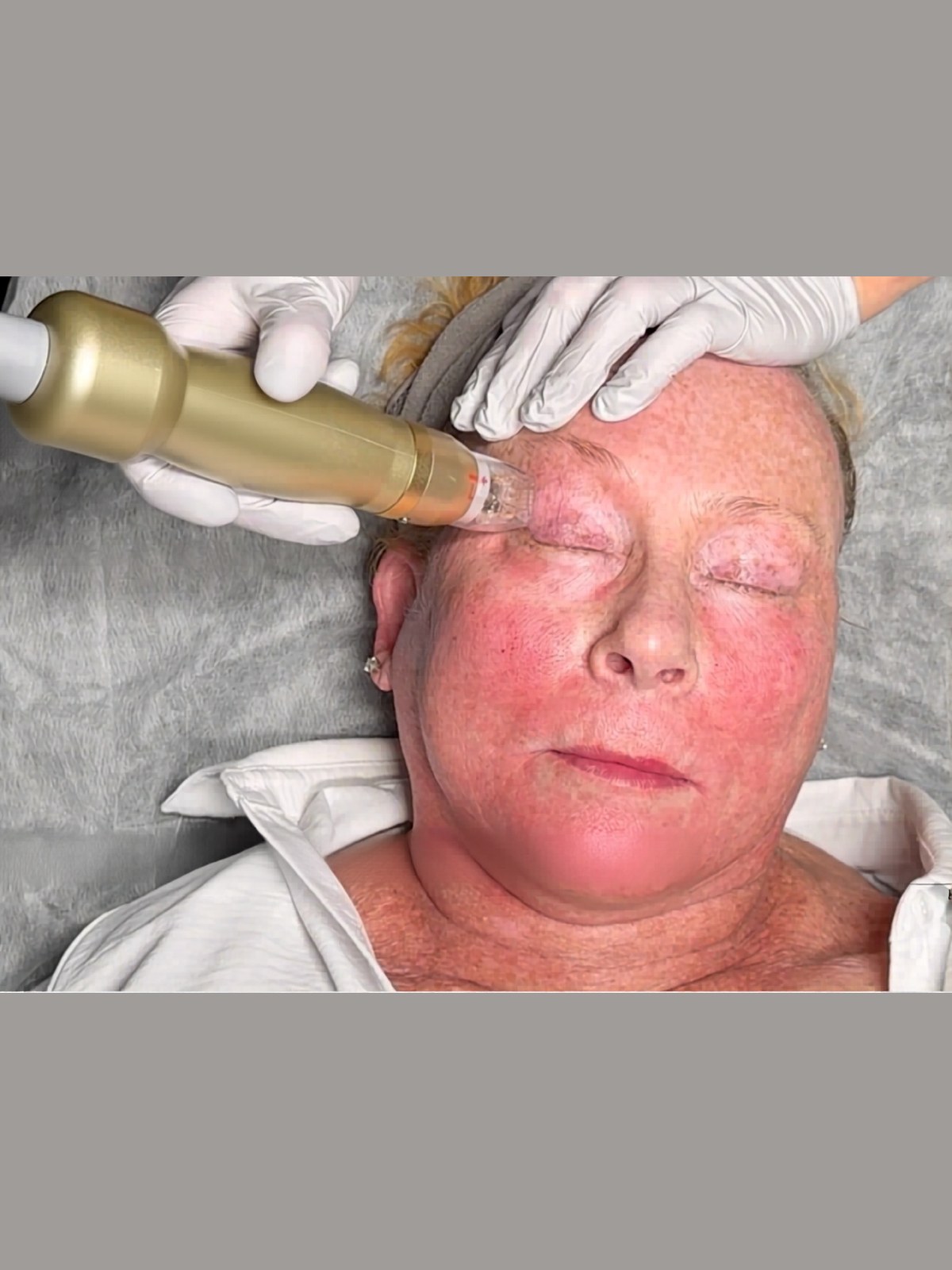 Resurfacing treatment