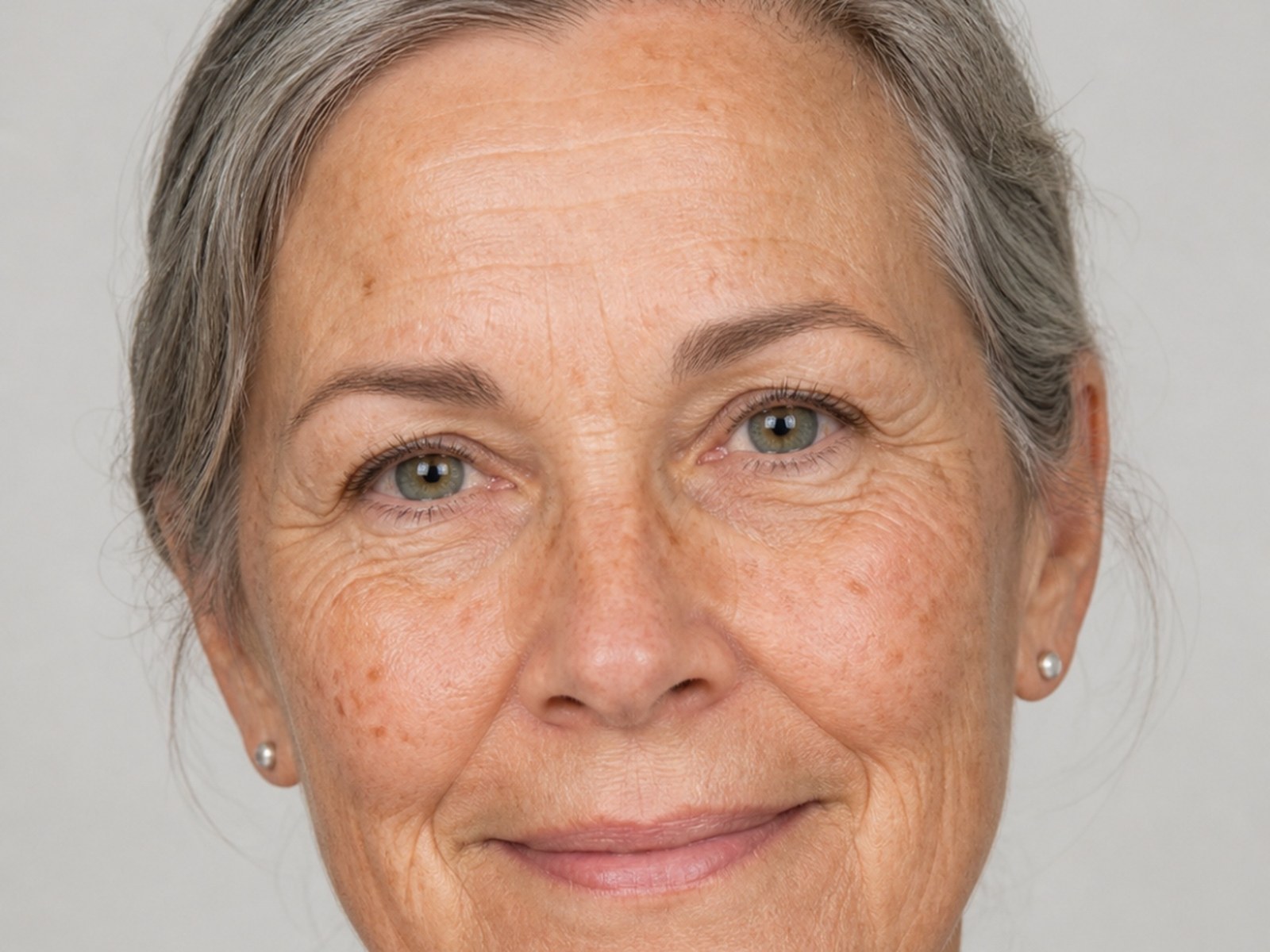 IPL Photofacial for sun spots and hyperpigmentation at Healing Aesthetics