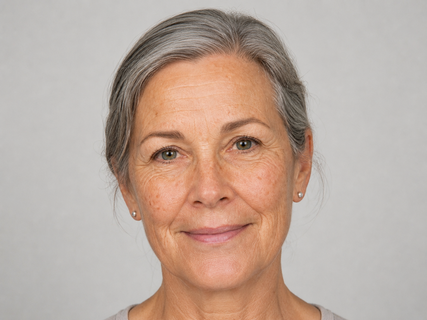 IPL Photofacial treatment at Healing Aesthetics