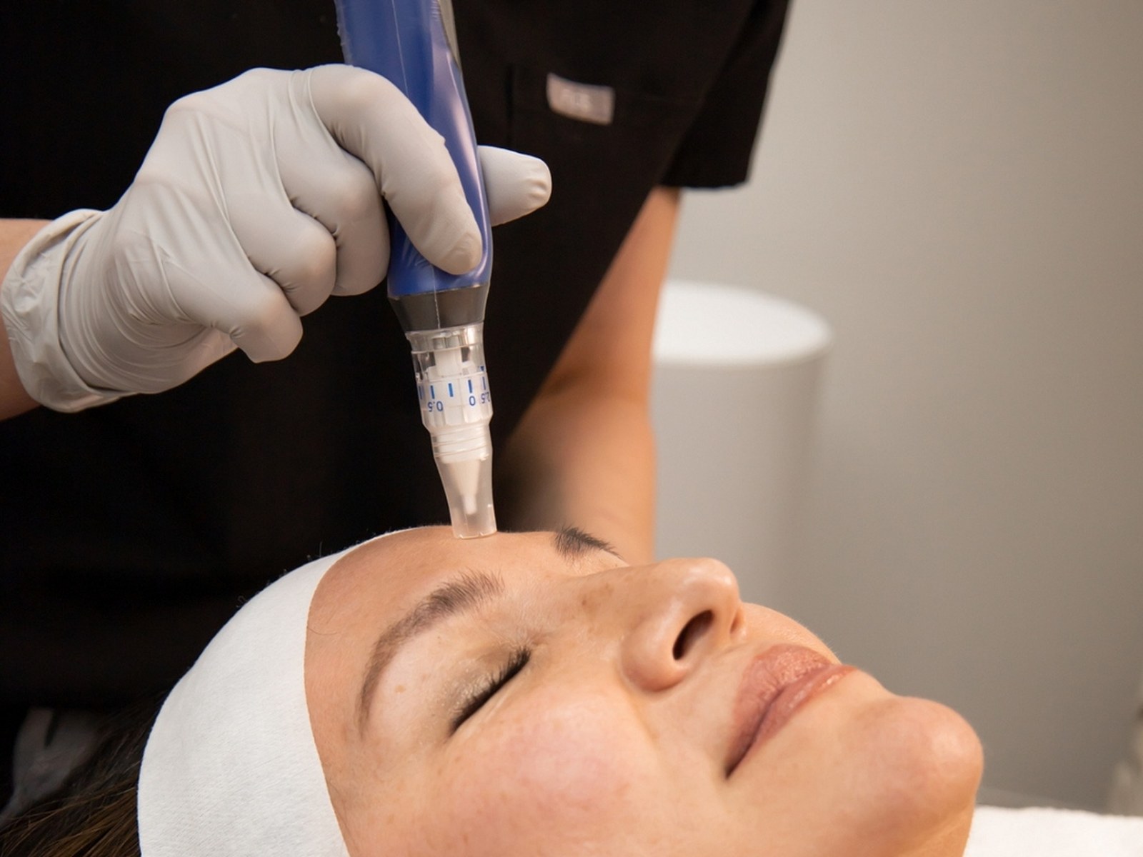Microneedling treatment at Healing Aesthetics