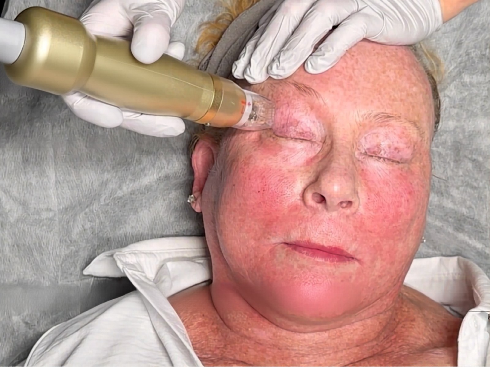 Sylfirm X RF for hyperpigmentation in darker skin tones at Healing Aesthetics