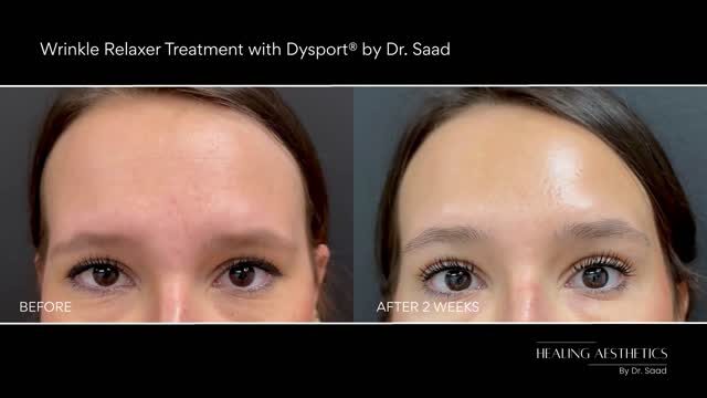 Botox before and after results